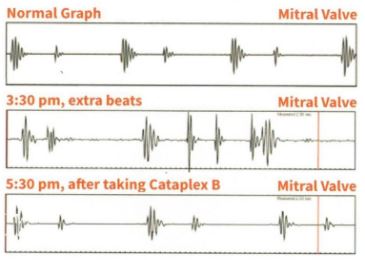 Heart Sound Recorded in Westchester CA